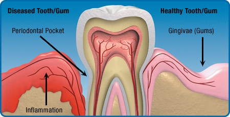 tandkødssygdomme